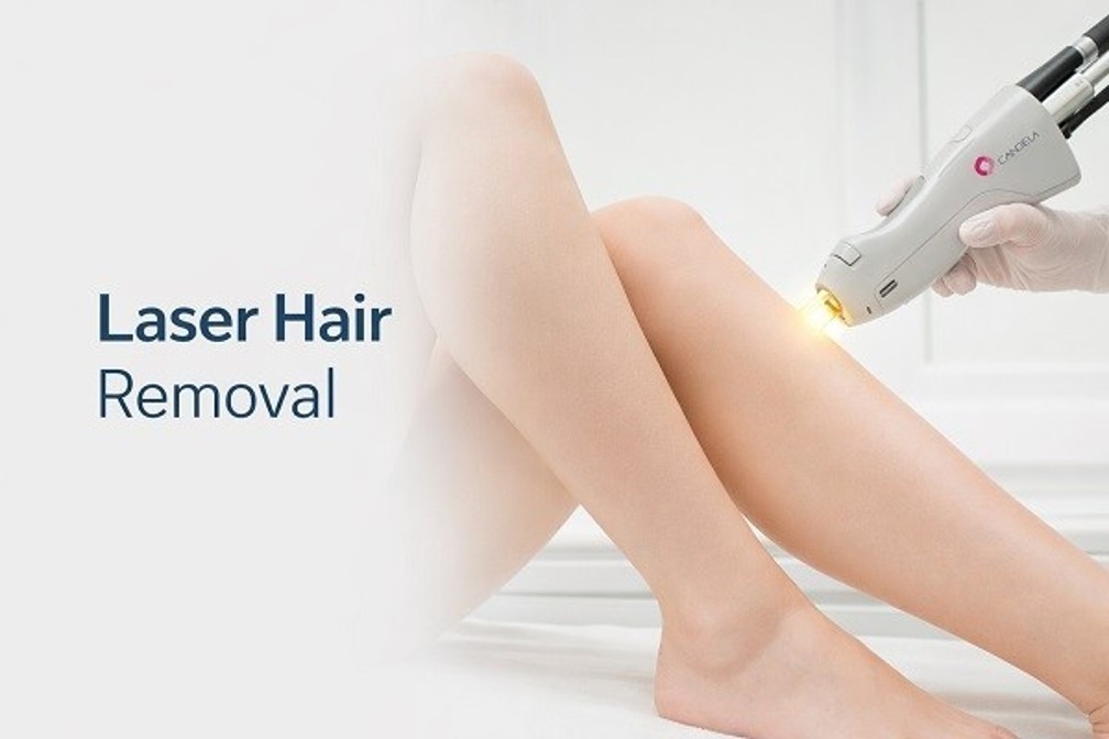 laser hair removal